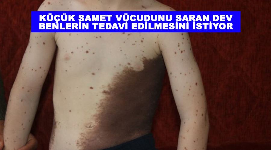 Küçük Samet vücudunu saran dev benlerin tedavi edilmesini istiyor